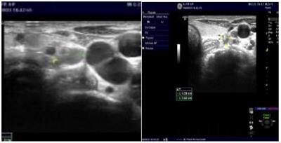 Severe secondary hyperparathyroidism in a chronic kidney disease patient treated with Radiofrequency ablation: One case report